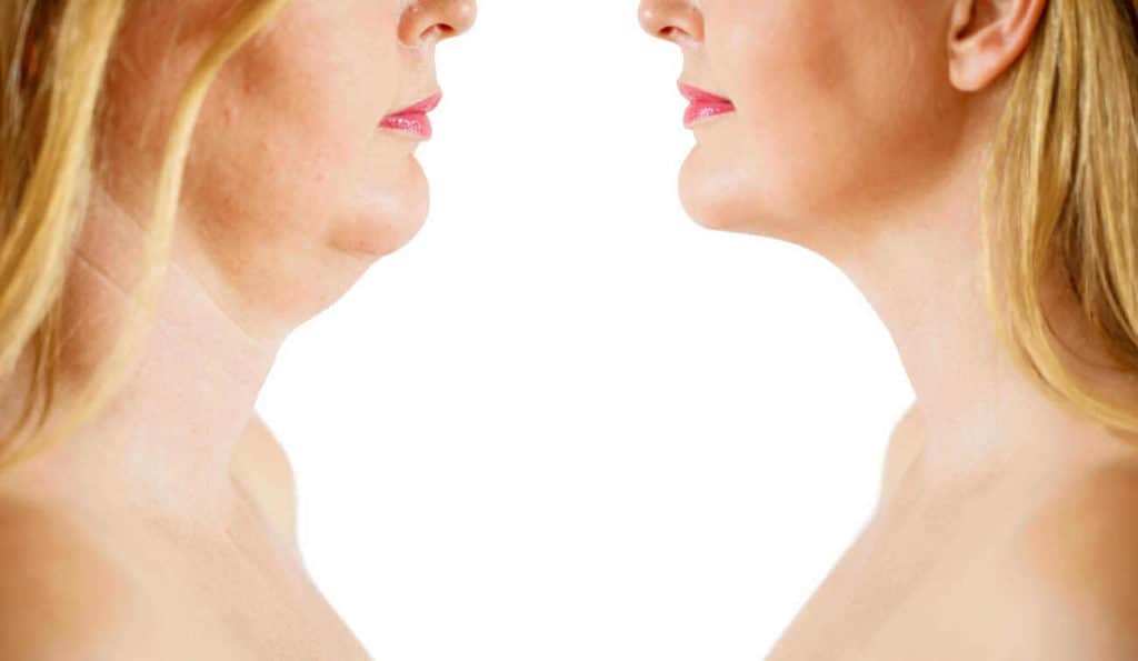 Double Chin treatment Havant before and after results