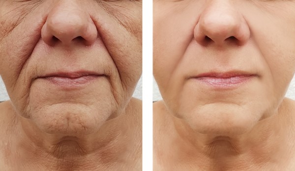 Learn more about Morpheus8 Treatment Havant today!