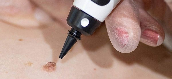 After Skin Tag Removal Havant
