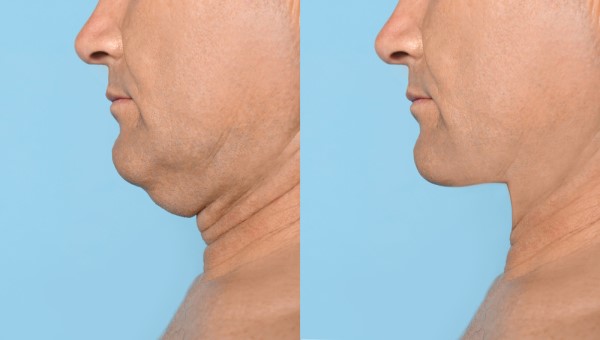 Which Non-Surgical Treatments Work Best for Jowls and Loose Skin Havant?
