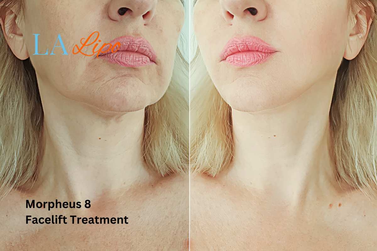 Turn back time with Morpheus8 Treatment Havant