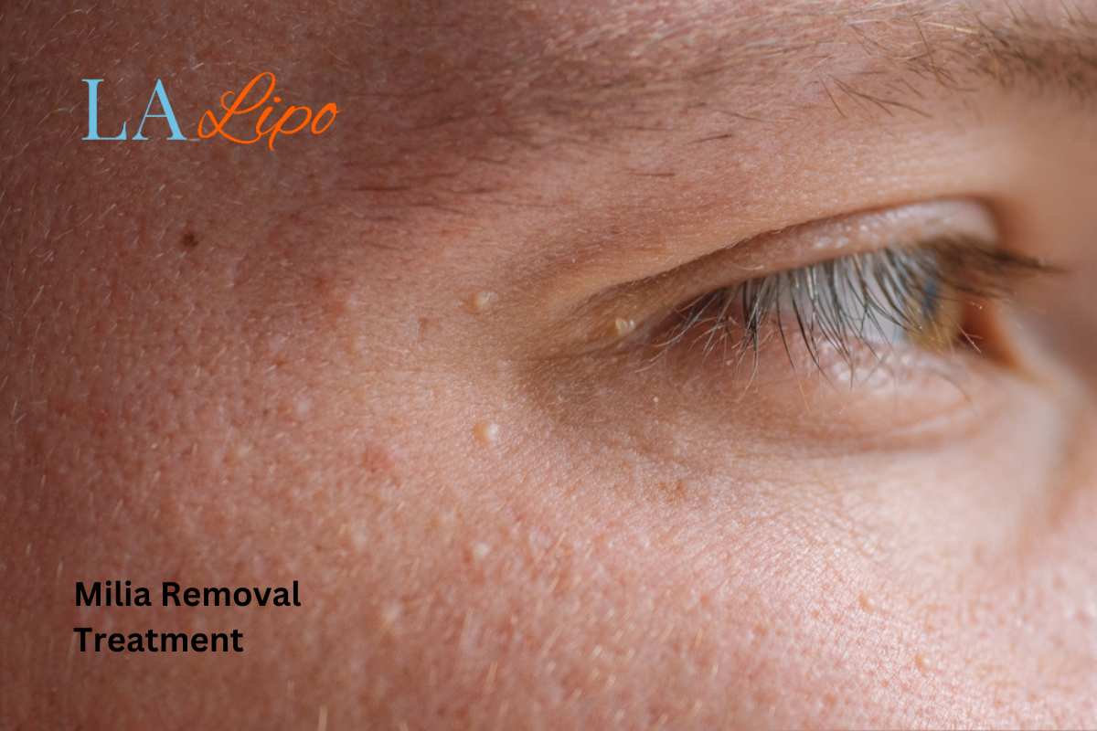 Cryopen Milia Removal: Is It the Easiest and Safest Option Havant?