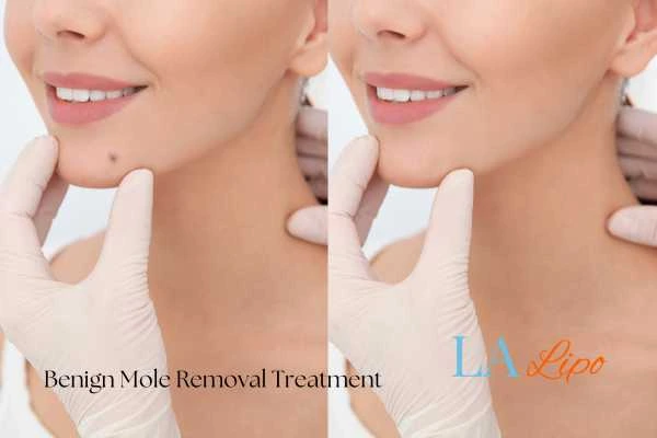 Before-and-after results following benign mole-removal treatment Havant