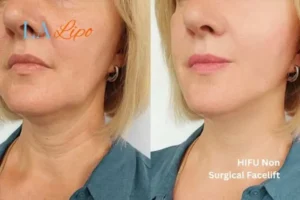 hi-fu for wrinkles Havant before and after results
