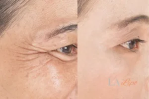 Before and after results of woman - HI-fu wrinkles reduction treatment Havant