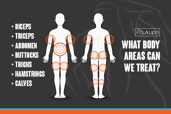 Graphic to show areas you can have LA-EMS Body Sculpting Havant treatment.