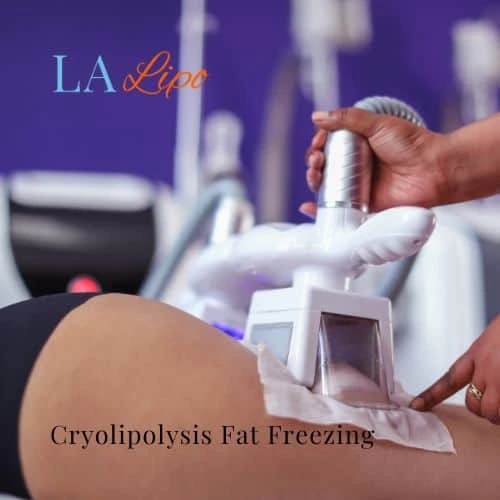 fat freezing - Cryolipolysis Havant