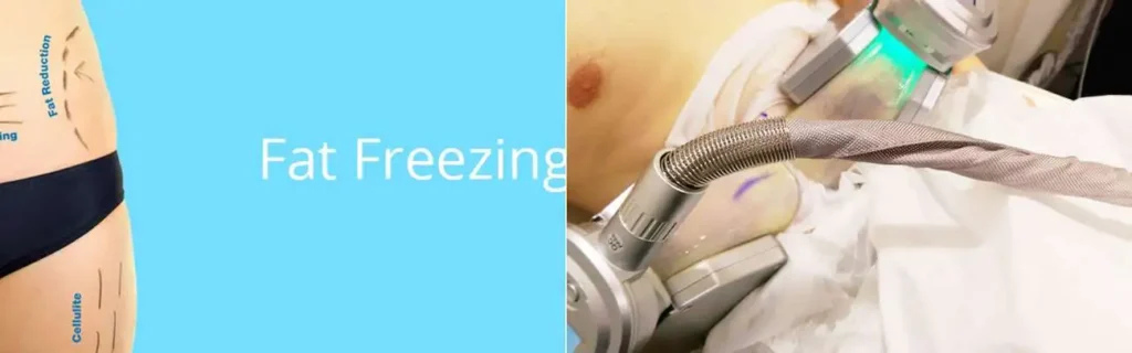 Fat freezing Havant on multiple areas of the body