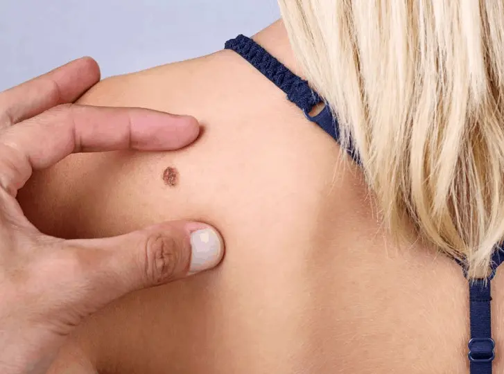 woman having mole removal Havant consultation before treatment.