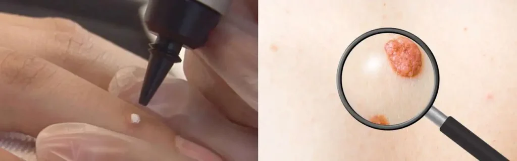 Cryopen for mole removal Havant - speak to our team today!