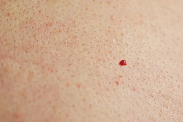 close up of a cherry angioma Havant