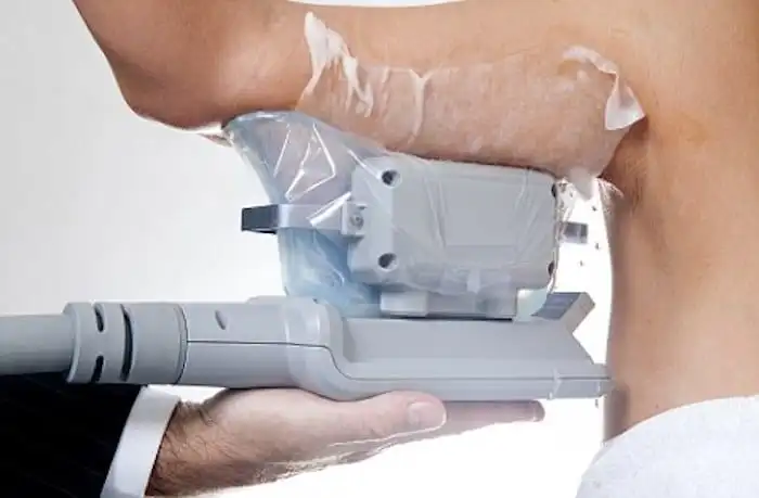 Picture of fat freezing Havant on the upper arms.