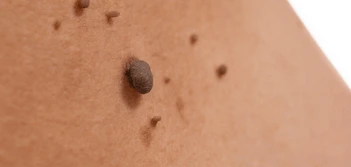 image of a skin tag Havant