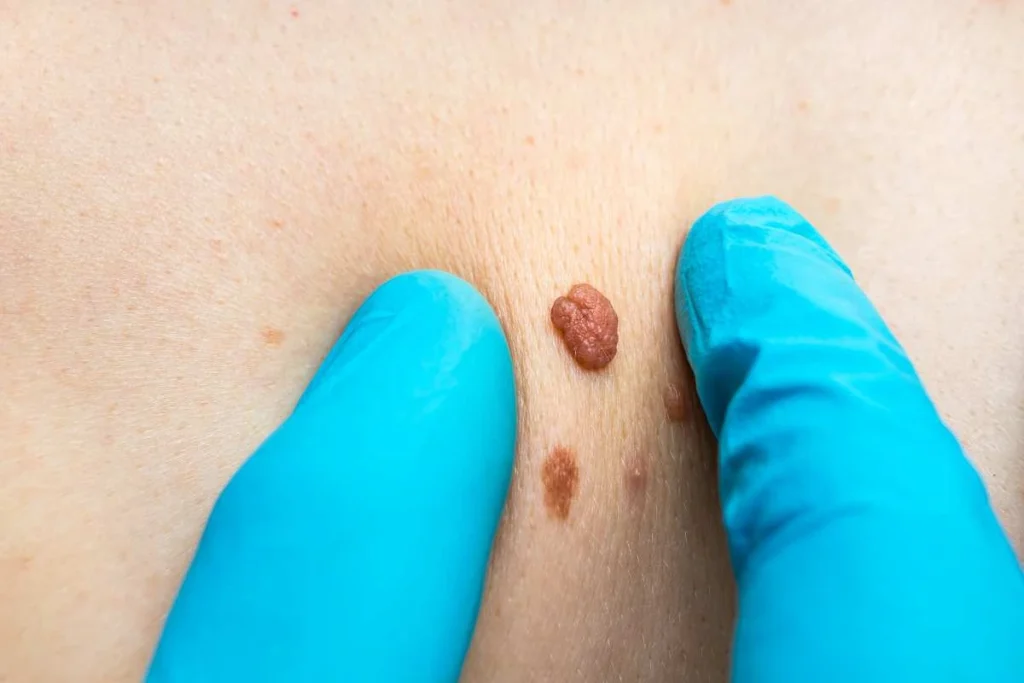 Consultant examining a skin tag Havant