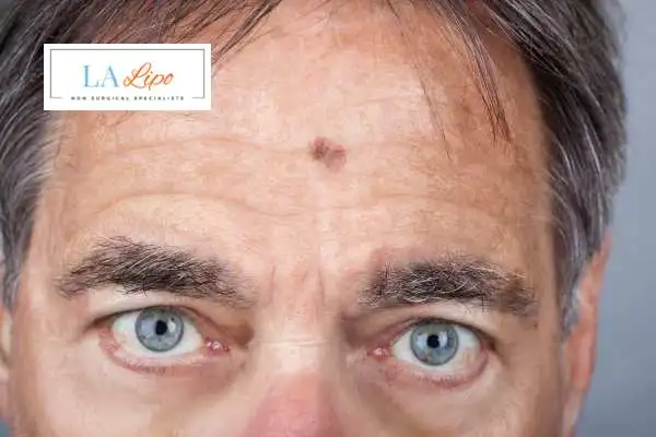 Solar Lentigo Removal Havant image of man with mark on his forehead