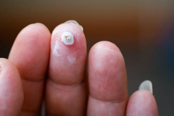 wart on person finger - cryotherapy to treat from LA LIPO Havant