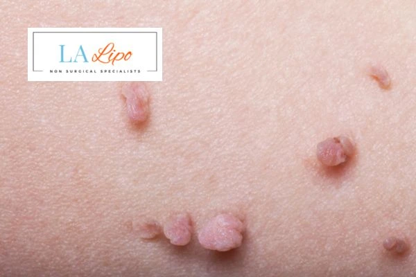Does cryopen skin tag removal Havant hurt? Find out now call our team today!