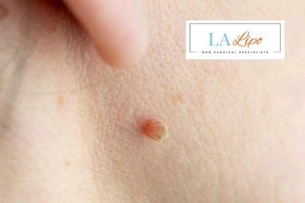 Book skin tag removal Havant today speak to our team now!