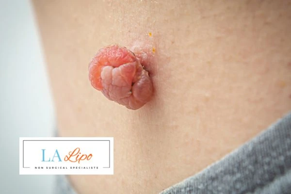 Interested in skin tag removal Havant? Concerned about the pain? Find out more today!