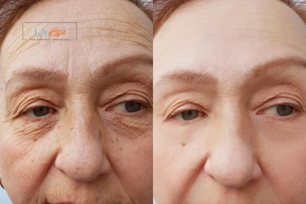 The powerful benefits of Morpheus8 Treatment Havant - Call Our team today!