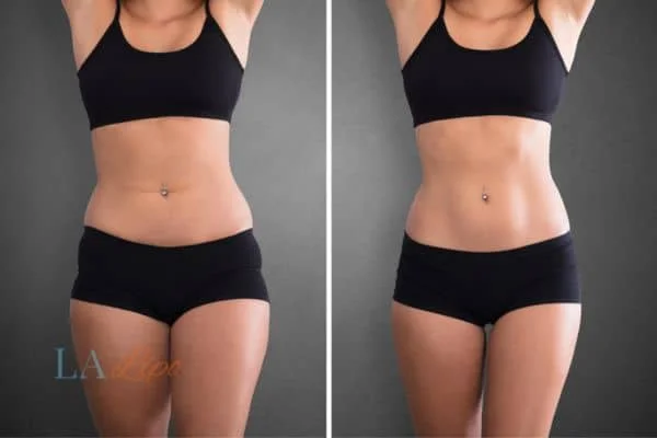 before and after results of non-surgical treatment to help a woman's body image and mental health Havant