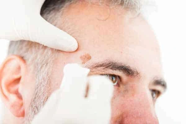 Age spots and elderly people Havant what is the link?