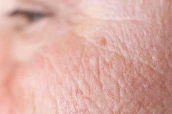 close up picture of a woman's face showing an age spot Havant