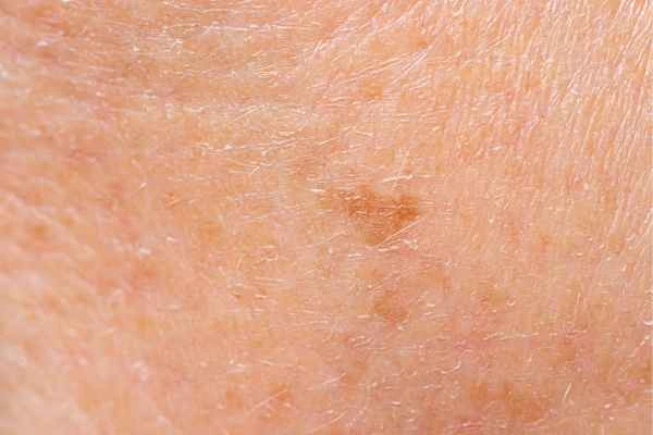 close up picture of age spots Havant