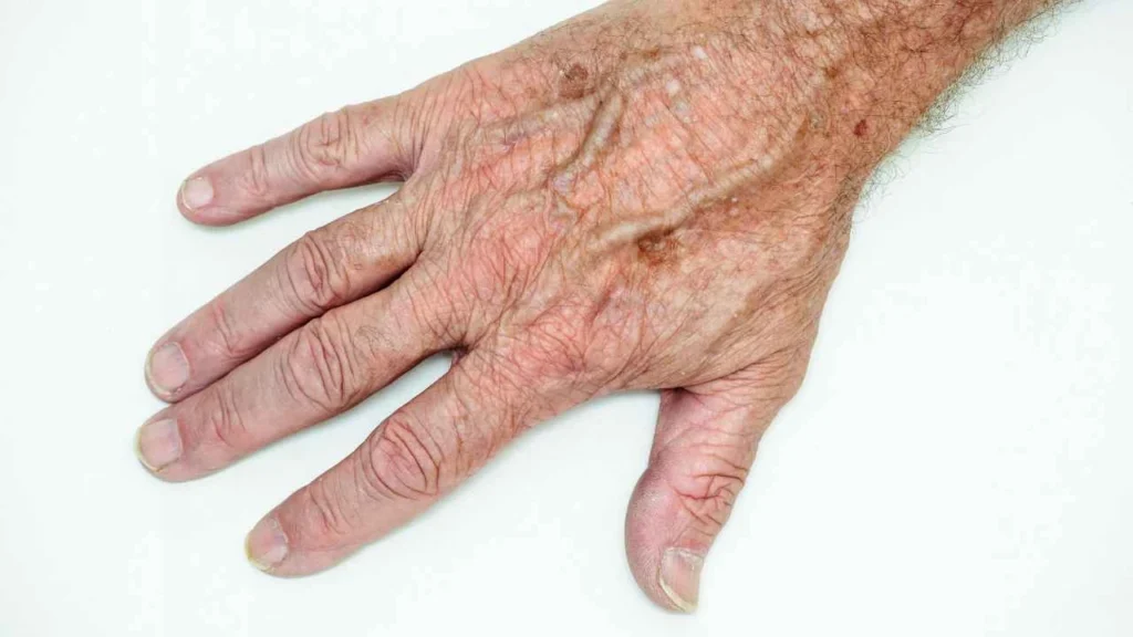 Male hand showing age spot Havant
