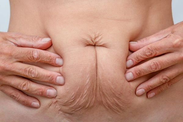 Should I Combine Diastasis Recti Treatment with Body Contouring for Better Results Havant?
