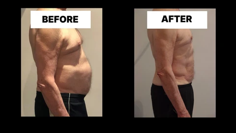 What Symptoms Can Diastasis Recti Cause in Men? Weak Core, Back Pain and Poor Posture Havant
